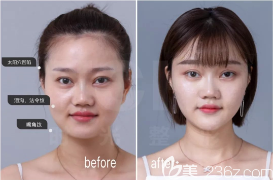 重慶時(shí)光公主玻尿酸填充<span style= 重慶時(shí)光公主玻尿酸填充<span style=