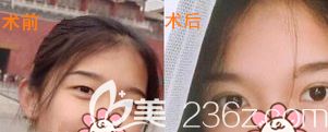 徐醫(yī)生為其他顧客做的眼綜合術前術后對比
