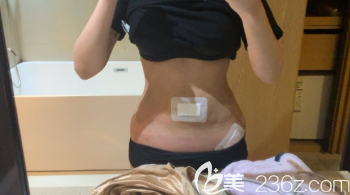 腰腹環(huán)吸1700ml：韓國babiline整形鄭熙妍女院長目前來看滿意