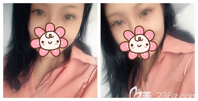 眼綜合修復(fù)術(shù)后27天恢復(fù)情況 眼綜合修復(fù)術(shù)后27天恢復(fù)情況