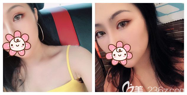 做完切開雙眼皮半年眼睛還是腫腫的 咨詢對(duì)比多家后到南京華韓奇致做了眼部修復(fù)術(shù)后27天不見失敗痕跡