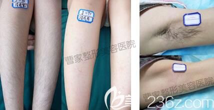 ？邵陽(yáng)曹家整形冰點(diǎn)脫毛真人前后對(duì)比照