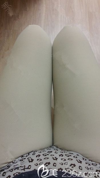 在韓國35mc做吸脂手術(shù)后2周 在韓國35mc做吸脂手術(shù)后2周