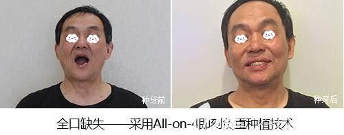 全口種植牙ALL-ON-4即刻種植案例前后效果對(duì)比圖 全口種植牙ALL-ON-4即刻種植案例前后效果對(duì)比圖
