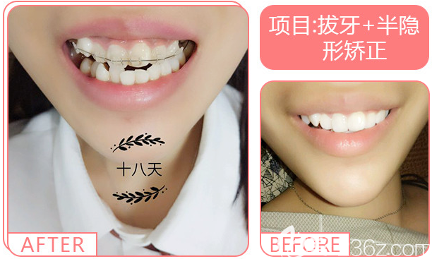 東莞壹加壹口腔醫(yī)院拔牙+半隱形牙齒矯正案例