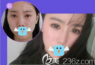 成都成美玻尿酸隆鼻前后對比效果圖