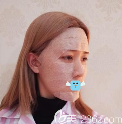 全臉自體脂肪填充術(shù)后即刻效果 全臉自體脂肪填充術(shù)后即刻效果