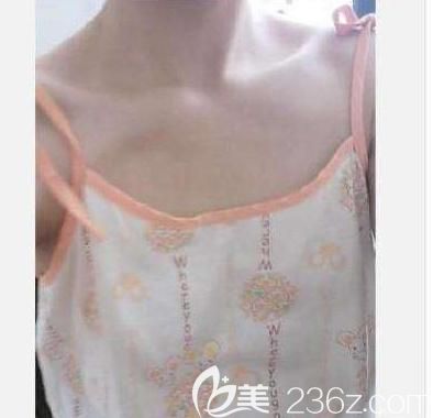 當(dāng)天就約了自體脂肪豐胸 當(dāng)天就約了自體脂肪豐胸