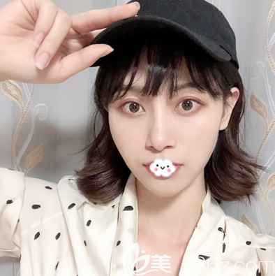 全臉自體脂肪填充三個月恢復(fù)過程圖 全臉自體脂肪填充三個月恢復(fù)過程圖