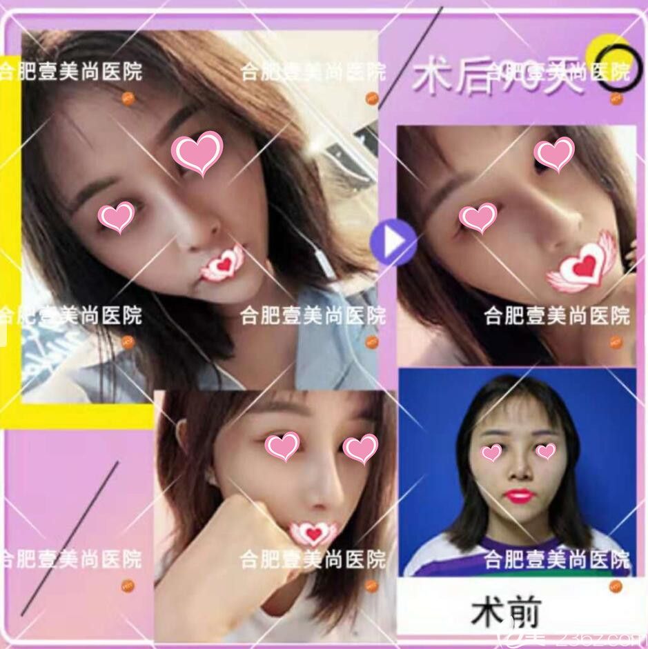 合肥壹美尚<!--<i data=20240703-sp></i>-->鼻綜合隆鼻案例