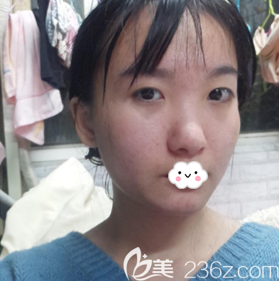 在深圳潤(rùn)澤瑞尼絲做雙眼皮隆鼻術(shù)前照片 在深圳潤(rùn)澤瑞尼絲做雙眼皮隆鼻術(shù)前照片