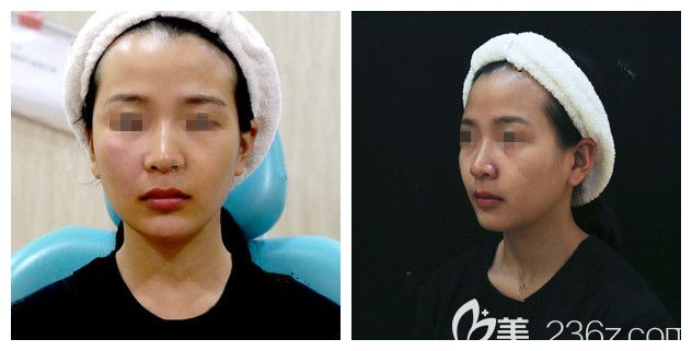 面診南京華韓奇致術(shù)前下巴短小 面診南京華韓奇致術(shù)前下巴短小