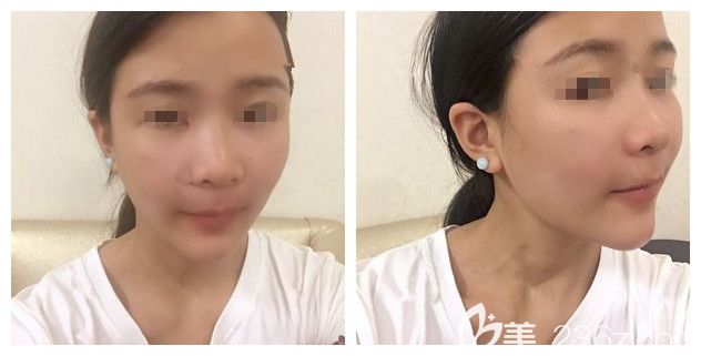 剛做完愛芙萊玻尿酸豐下巴術(shù)后 剛做完愛芙萊玻尿酸豐下巴術(shù)后