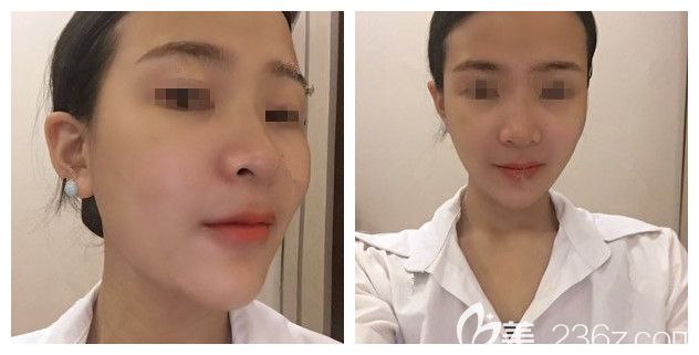 術(shù)后一周玻尿酸豐下巴效果 術(shù)后一周玻尿酸豐下巴效果