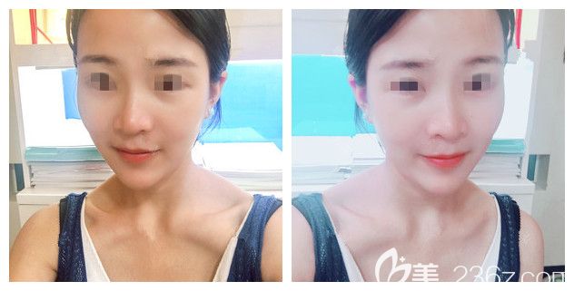 不想放假體異物還擔(dān)心創(chuàng)傷恢復(fù)，所以在南京華韓奇致做1ml愛芙萊注射下巴還整理出適合墊下巴的玻尿酸品牌