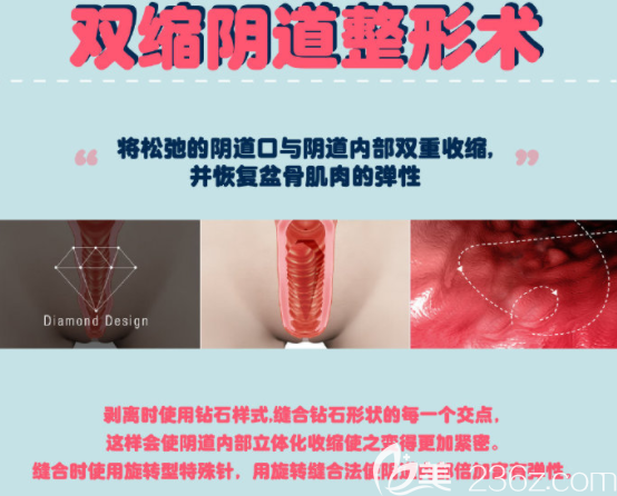 雙帶陰道整形術