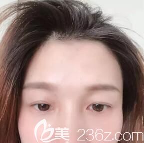 在懷化華美做雙眼皮術(shù)前照 在懷化華美做雙眼皮術(shù)前照