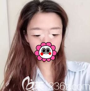 在華美做雙眼皮術(shù)后第1天 在華美做雙眼皮術(shù)后第1天