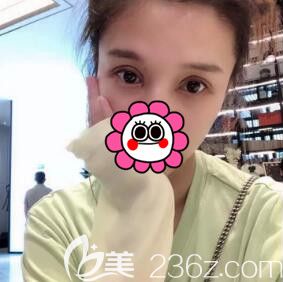 在懷化做雙眼皮術(shù)后一周效果 在懷化做雙眼皮術(shù)后一周效果