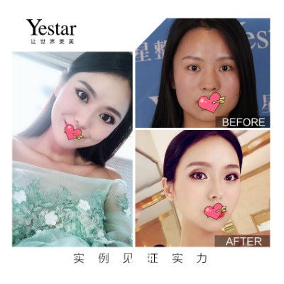 合肥藝星整形耿繼龍美杜莎眼綜合+鼻綜合+瘦臉案例前后效果對比圖