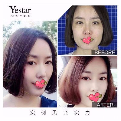 合肥藝星整形邵輝全臉埋線提升案例