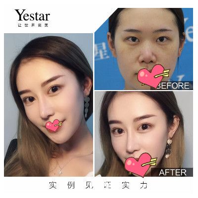 合肥藝星孫洋手術(shù)怎么樣？孫洋院長鼻綜合+眼綜合案例來驗證