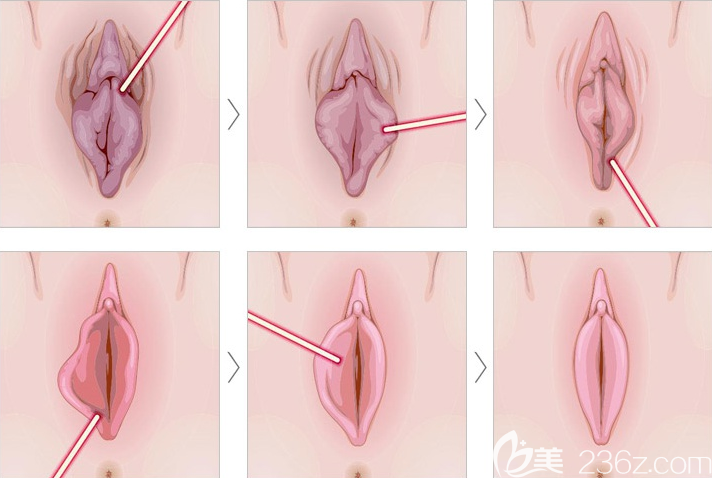 激光小陰唇整形 激光小陰唇整形
