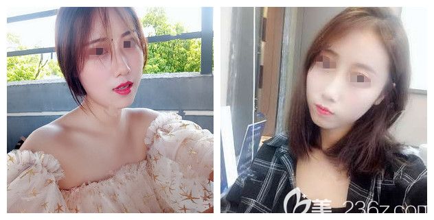 南京自體脂肪填充貴嗎?了解過價格后在南京藝星還做了硅膠隆鼻+手術(shù)縮鼻頭的綜合鼻整形