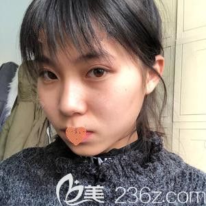 在張家口天宏注射瘦臉后面部微腫 在張家口天宏注射瘦臉后面部微腫