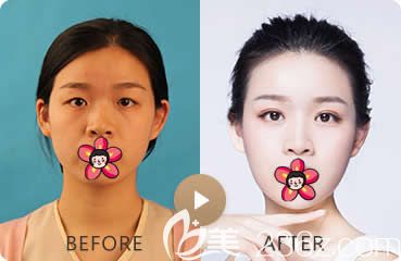 臺(tái)州藝星阮凱割雙眼皮案例