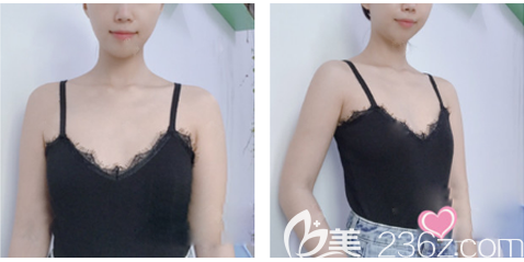 在深圳潤(rùn)澤瑞尼絲做隆胸術(shù)前照片 在深圳潤(rùn)澤瑞尼絲做隆胸術(shù)前照片