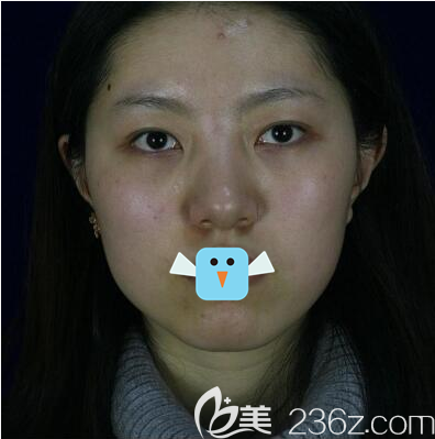 在四川成都友誼整形美容醫(yī)院做鼻子前照片 在四川成都友誼整形美容醫(yī)院做鼻子前照片