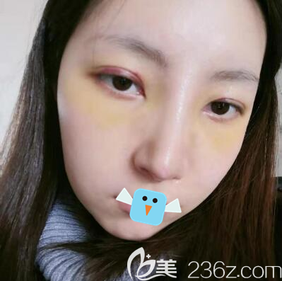 成都向朝肋軟骨隆鼻拆線后效果 成都向朝肋軟骨隆鼻拆線后效果