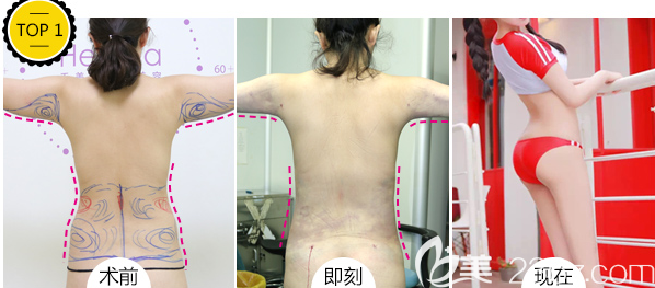 北京禾美嘉任學(xué)會醫(yī)生腰腹吸脂+手臂吸脂案例