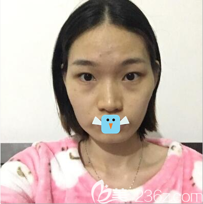 顴骨顴弓下頜角整形前照片 顴骨顴弓下頜角整形前照片