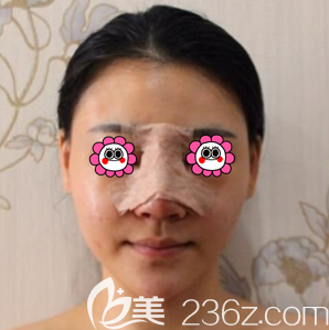 張振醫(yī)生給我做鼻綜合第3天樣子