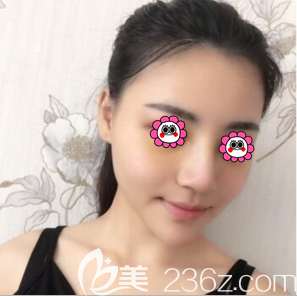 我在北京京韓做鼻綜合第10天效果