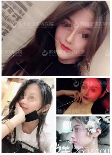 為什么別人都在考慮肋軟骨取出留疤擔(dān)心后遺癥，我卻在蘇州康美做了鼻綜合還給你們分享鼻整形價格表
