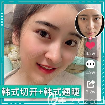 在無錫愛思特做眼部綜合整形案例