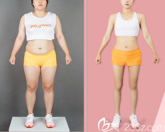 韓國365mc醫(yī)院全身吸脂<span style= 韓國365mc醫(yī)院全身吸脂<span style=