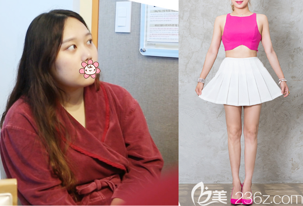 韓國365mc醫(yī)院做大腿腰腹部吸脂效果怎么樣 韓國365mc醫(yī)院做大腿腰腹部吸脂效果怎么樣