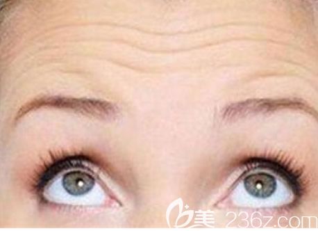 青少年有抬頭紋正常嗎