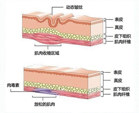 除皺原理示意圖