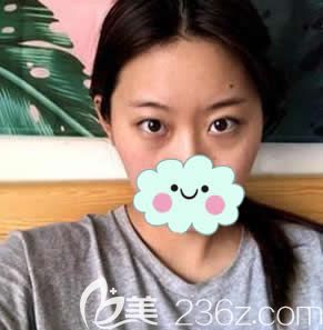 在臺(tái)州藝星做雙眼皮和開眼角前 在臺(tái)州藝星做雙眼皮和開眼角前