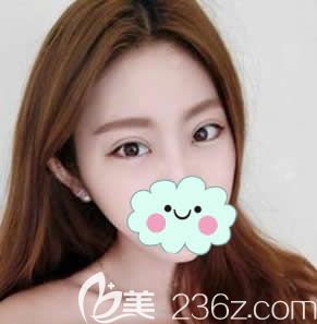 全切雙眼皮和開眼角30天效果圖片 全切雙眼皮和開眼角30天效果圖片