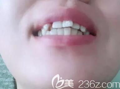 我在昆明德韓口腔做牙齒矯正前照片 我在昆明德韓口腔做牙齒矯正前照片