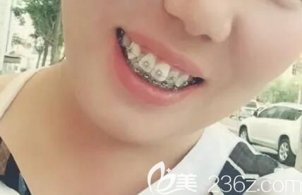 在昆明德韓口腔做牙齒矯正剛戴牙套 在昆明德韓口腔做牙齒矯正剛戴牙套