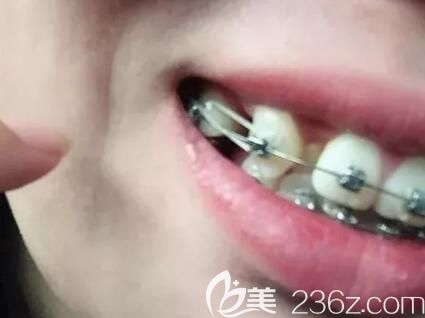 我在昆明德韓口腔做牙齒矯正45天帶皮筋 我在昆明德韓口腔做牙齒矯正45天帶皮筋