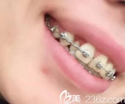 我在昆明德韓口腔戴牙套第4個月 我在昆明德韓口腔戴牙套第4個月