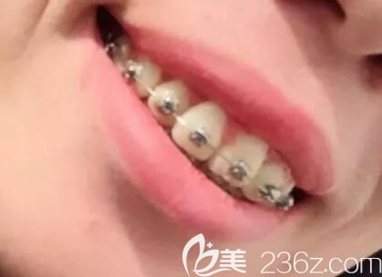 我在昆明德韓口腔做自鎖托槽矯正第6個月 我在昆明德韓口腔做自鎖托槽矯正第6個月